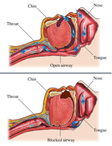 Stacked graphic images showing Open Airways on top and Blocked Airways from Sleep Apnea on the bottom
