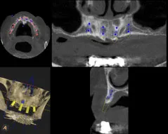 CT scan: Digital images of a patient's mouth throughout dental Implant procedure