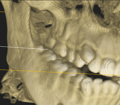 Cone Beam CT of upper and lower jaws and Wisdom Teeth for extraction