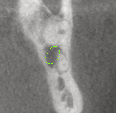 Cone Beam CT image showing a Wisdom Teeth
